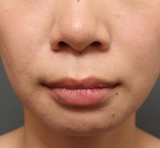 20代女性の人中短縮(リップリフト) Before 症例写真