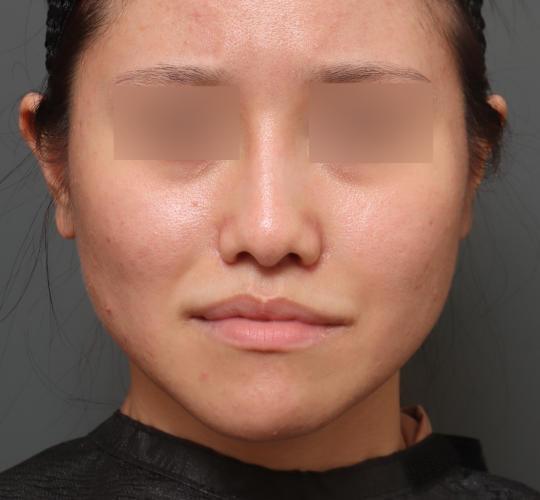 20代女性の鼻プロテーゼ After 症例写真