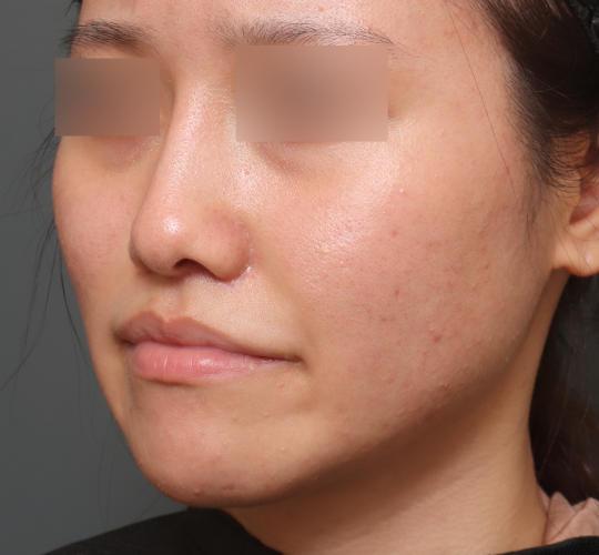 20代女性の鼻プロテーゼ After 症例写真