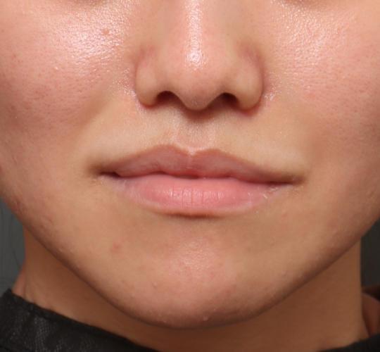 20代女性の鼻プロテーゼ After 症例写真