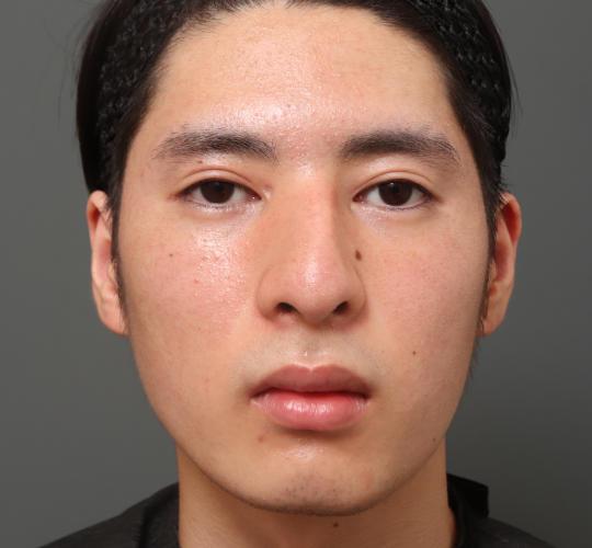 10代男性の鼻骨骨切り After 症例写真