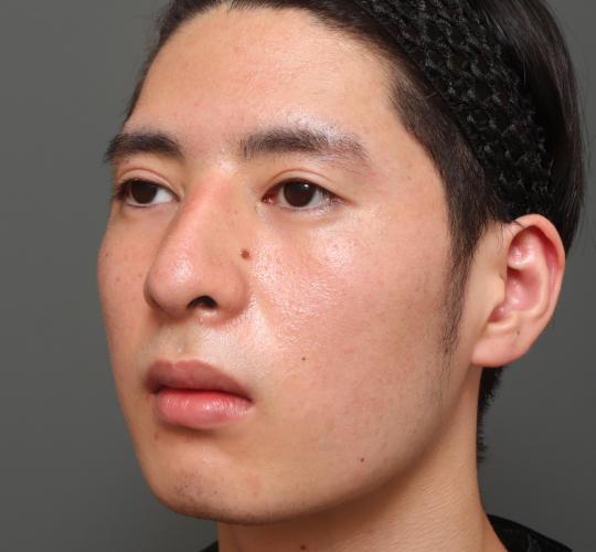 10代男性の鼻骨骨切り After 症例写真