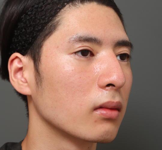 10代男性の鼻骨骨切り After 症例写真