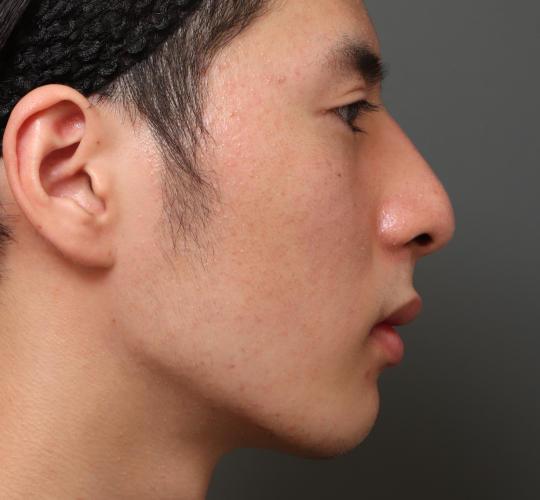 10代男性の鼻骨骨切り After 症例写真