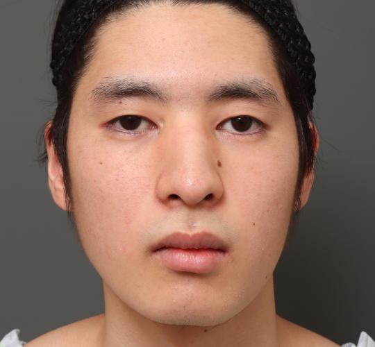 10代男性の鼻骨骨切り Before 症例写真