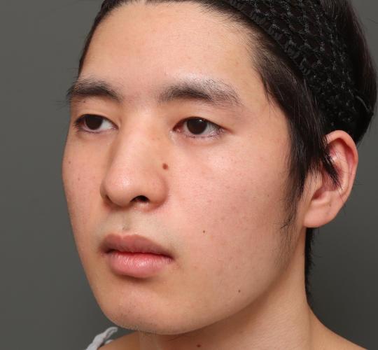 10代男性の鼻骨骨切り Before 症例写真