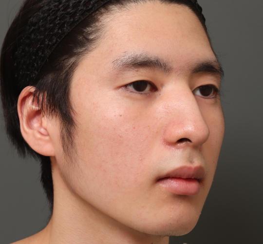 10代男性の鼻骨骨切り Before 症例写真