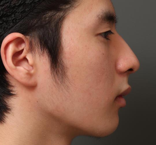 10代男性の鼻骨骨切り Before 症例写真