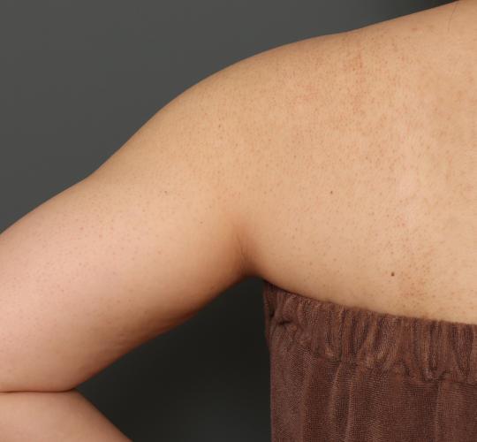 20代女性の毛孔性苔癬・角化症 Before 症例写真