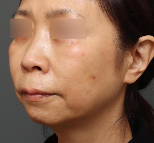 50代女性のグロウHIFUセレクトプラス After 症例写真