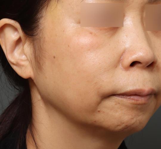 50代女性のシミ・そばかす After 症例写真