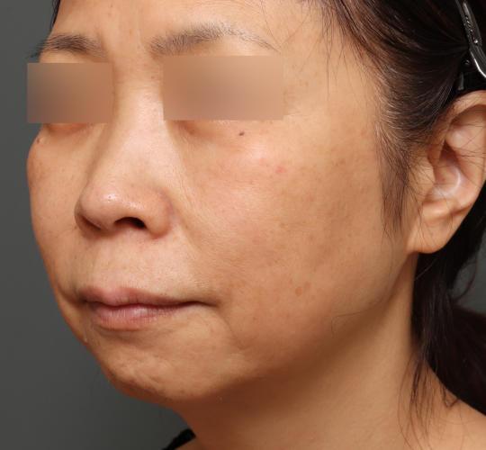 50代女性のグロウHIFUセレクトプラス Before 症例写真