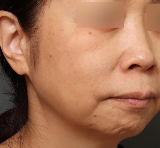 50代女性のシミ・そばかす Before 症例写真