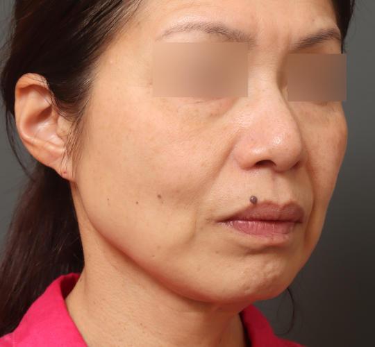 50代女性のグロウHIFUセレクトプラス After 症例写真