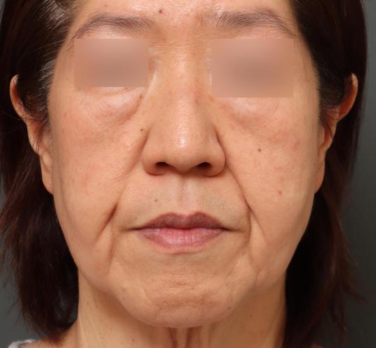 50代女性のグロウHIFUセレクトプラス After 症例写真
