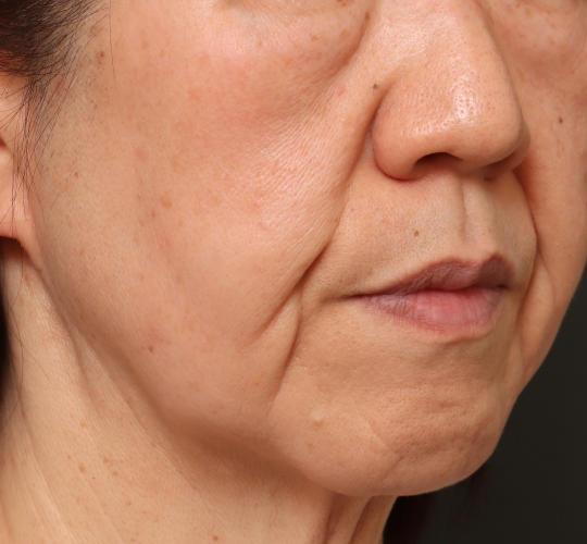 50代女性のグロウHIFUセレクトプラス After 症例写真