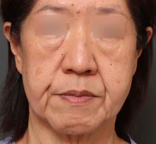 50代女性のグロウHIFUセレクトプラス Before 症例写真