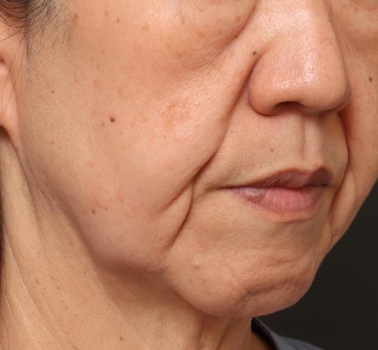 50代女性のグロウHIFUセレクトプラス Before 症例写真