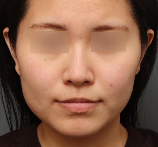 20代女性の肌管理毛穴スリークスキン（ダーマペン4） After 症例写真