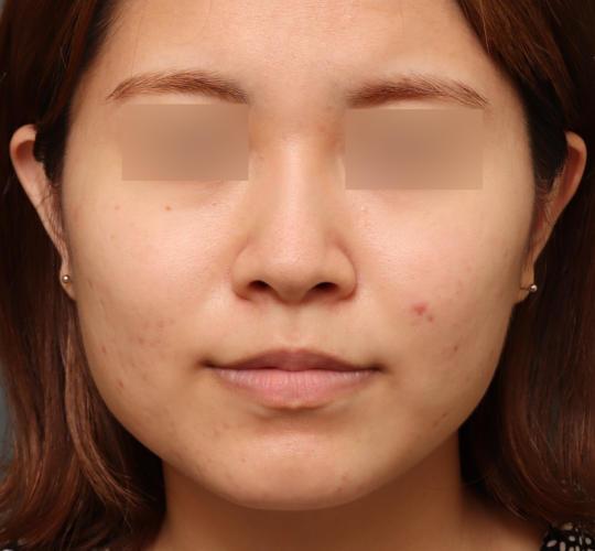 20代女性の肌管理毛穴スリークスキン（ダーマペン4） Before 症例写真