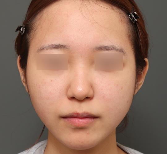 20代女性の毛穴・黒ずみ After 症例写真