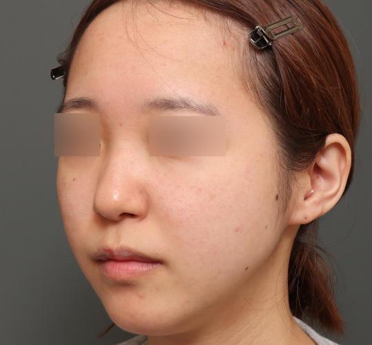 20代女性の肌管理毛穴スリークスキン（ダーマペン4） After 症例写真