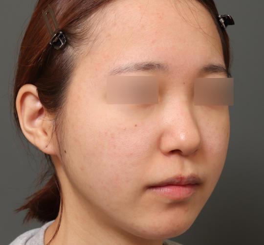 20代女性の肌管理毛穴スリークスキン（ダーマペン4） After 症例写真