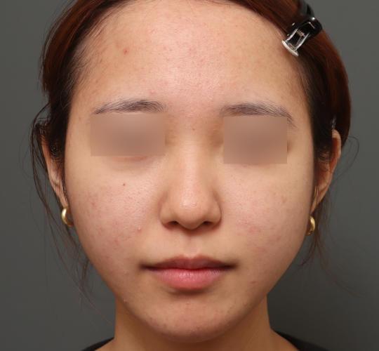 20代女性の毛穴・黒ずみ Before 症例写真