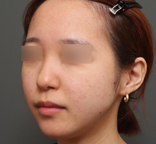 20代女性の肌管理毛穴スリークスキン（ダーマペン4） Before 症例写真