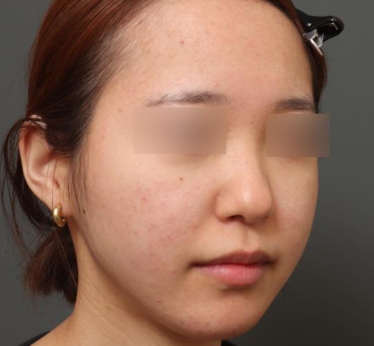 20代女性の肌管理毛穴スリークスキン（ダーマペン4） Before 症例写真