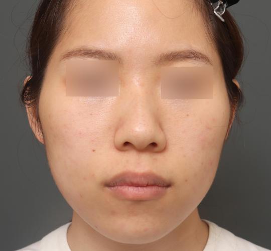 20代女性の毛穴・黒ずみ After 症例写真