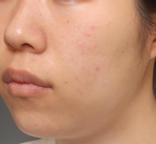 20代女性の肌管理毛穴スリークスキン（ダーマペン4） After 症例写真