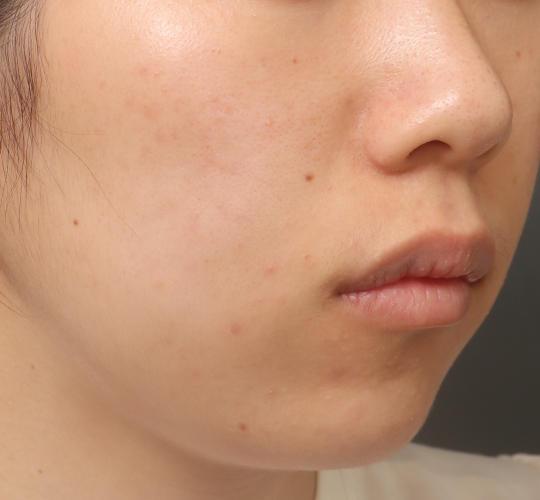 20代女性の肌管理毛穴スリークスキン（ダーマペン4） After 症例写真