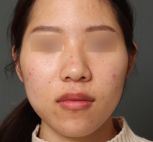 20代女性の毛穴・黒ずみ Before 症例写真