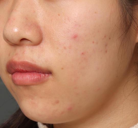 20代女性の肌管理毛穴スリークスキン（ダーマペン4） Before 症例写真