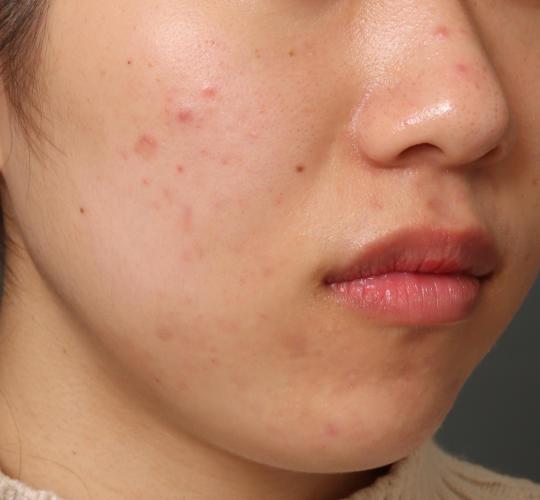 20代女性の肌管理毛穴スリークスキン（ダーマペン4） Before 症例写真