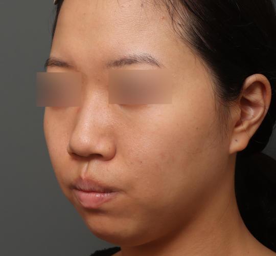20代女性の毛穴・黒ずみ After 症例写真