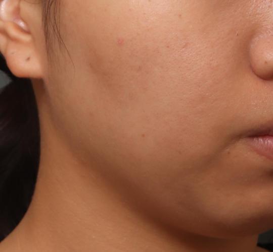 20代女性の肌管理毛穴スリークスキン(ダーマペン4) After 症例写真