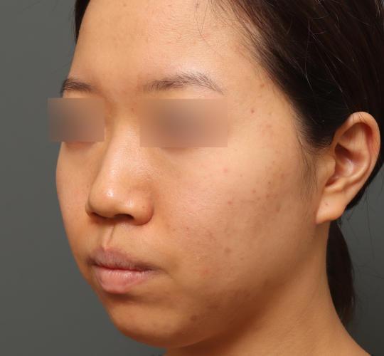 20代女性の毛穴・黒ずみ Before 症例写真