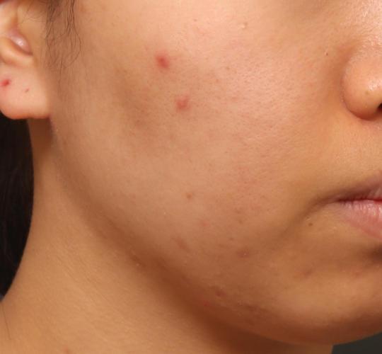 20代女性の肌管理毛穴スリークスキン(ダーマペン4) Before 症例写真