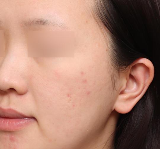 20代女性の毛穴・黒ずみ After 症例写真