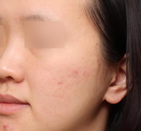 20代女性の毛穴・黒ずみ Before 症例写真