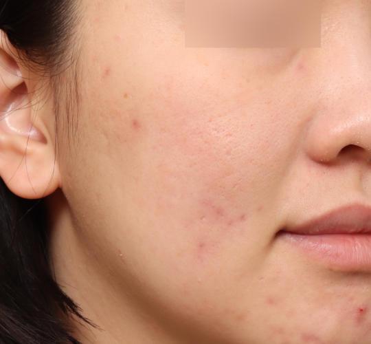 20代女性のヴァンパイアフェイシャル Before 症例写真