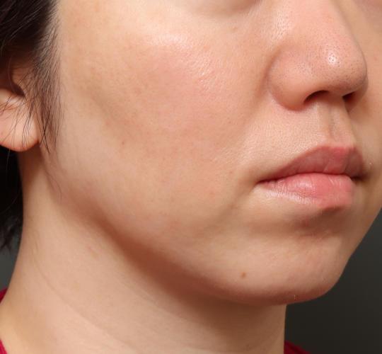 40代女性のヴァンパイアフェイシャル After 症例写真