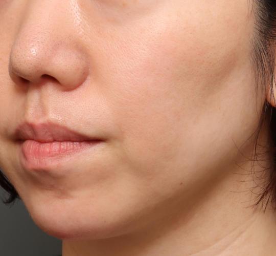 40代女性の毛穴・黒ずみ Before 症例写真