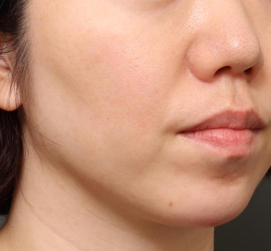 40代女性のヴァンパイアフェイシャル Before 症例写真