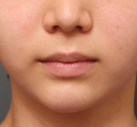 10代女性の人中短縮ボトックス Before 症例写真