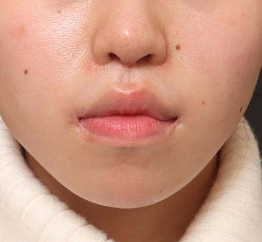 20代女性の人中短縮（リップリフト） After 症例写真