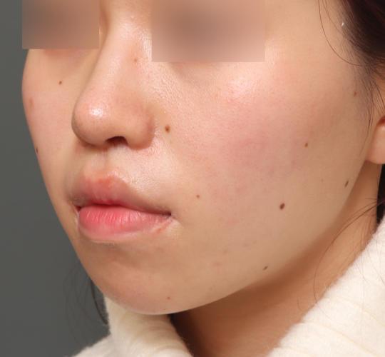 20代女性の人中短縮(リップリフト) After 症例写真