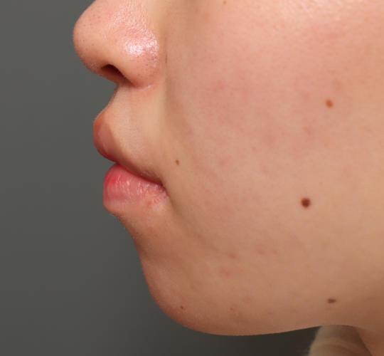 20代女性の人中短縮（リップリフト） After 症例写真